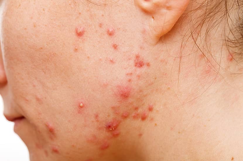 El acné aparece cuando los poros se obstruyen debido a un exceso de producción de grasa en la piel.